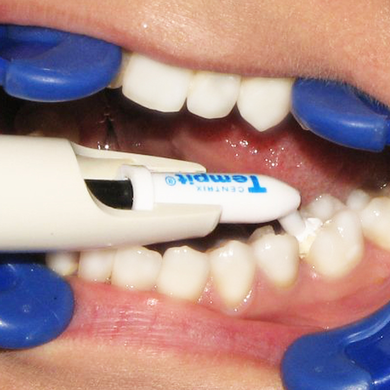Tempit Moisture-Activated Temporary Filling & Sealing Material