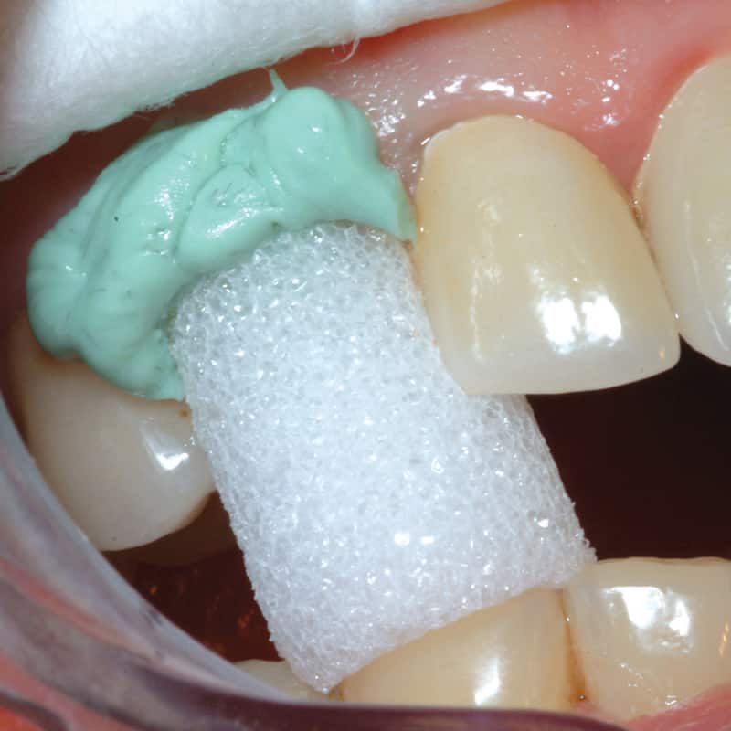 GingiCap being used in the mouth